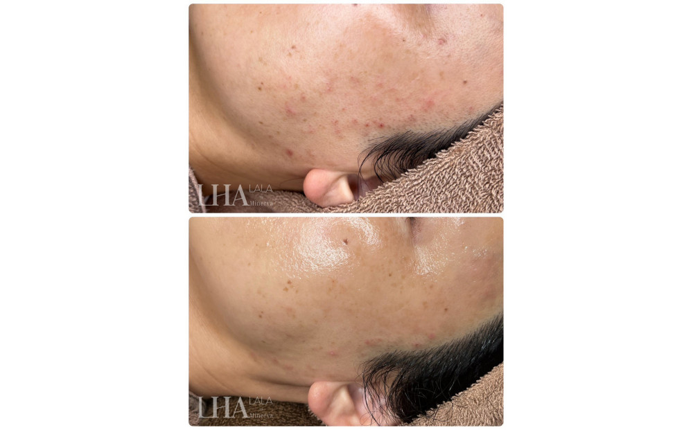 美容鍼＋ララピール&nbsp;（1回体験）