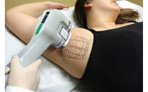 【切らないワキガ治療】ミラドライ（両脇）【トリプル照射】広範囲照射