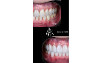 ブラックフィルム施術券(2本)