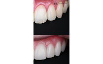 ブラックフィルム施術券(14本)