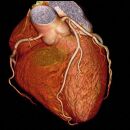 心臓ドック　冠動脈CTコース